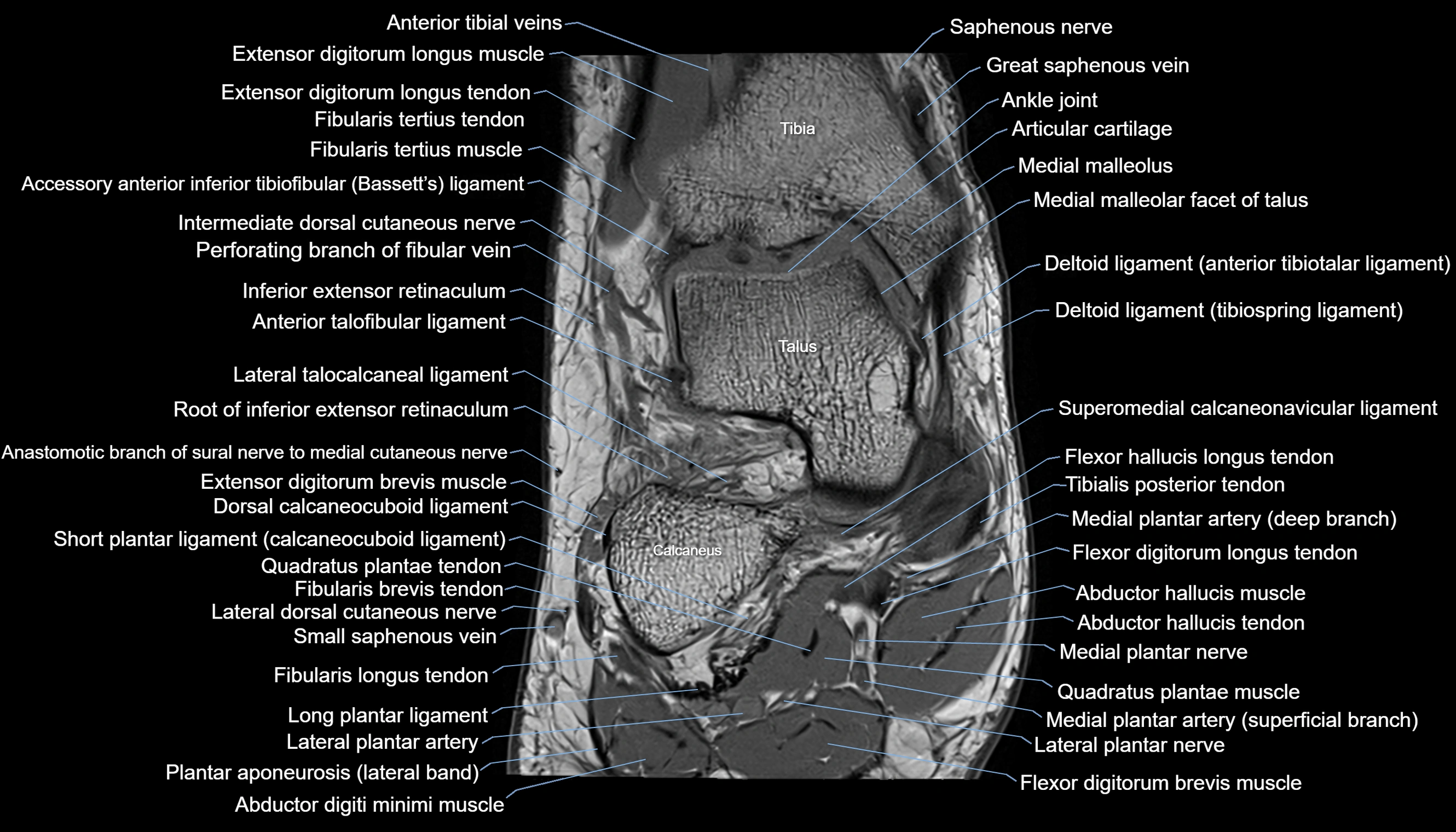 Ankle coronal anatomy 3T MRI images -img-11001-00007.webp